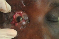 RTA eyelid malformation for repair