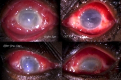 hyperacute bilateral gonococcal keratoconjunctivitis with corneal melt in a relatively young lady