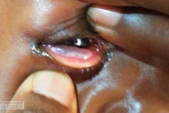 inclusion cyst lower lid conjunctiva