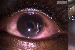 iris prolapse post bacterial corneal ulcer perforation managed with conjunctival flap