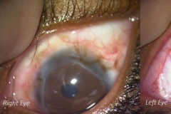 mooren&amp;amp;#039;s ulcer right eye temporarily stabilized, left eye incipient progression managed with conjunctivectomy
