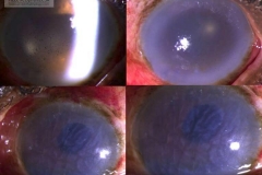 pseudophakic keratopathy - post op acute hypertension + macrocystic edema resulted in stromal and descemet edema