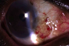 pterygium excision cautery-fixed conjunctival autograft