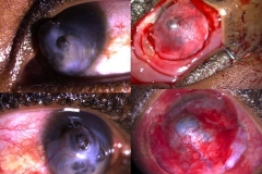 staphyloma anterior post-uveitic managed with pedunculated conjunctival flap in a lady 35yo