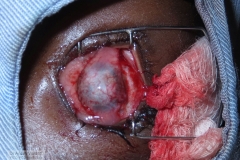 Tenonplasty