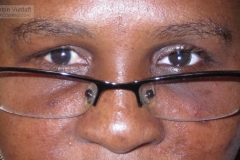 artificial eye in bilaterally blind patient