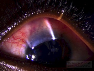 Juvenile Open Angle Glaucoma