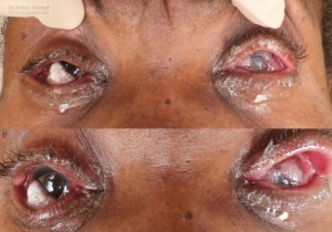 Bilateral advanced conjunctival squamous cell carcinoma