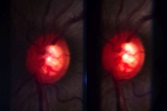 Stereo-image of cupping in bilateral juvenile open angle glaucoma in 17yo girl (right eye - moderate stage, left eye - end stage). IOPs 36 and 57. Vision 6/6 and NLP. Trabeculectomy scheduled for RE and for LE (in the latter - to prevent neovascular glaucoma complication).
