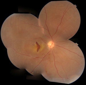 Macular tear and diffuse retinal detachment in juvenile maculoschisis
