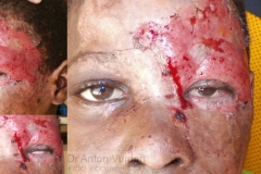 Thermal burn resulted in upper and lower eyelid cicatricial ectropion, and necessitated skin grafting