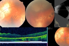Probable choroidal melanoma in single seeing eye