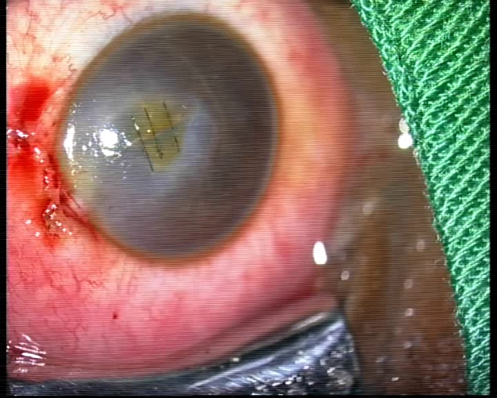 Fish-hook eye perforation wound closure