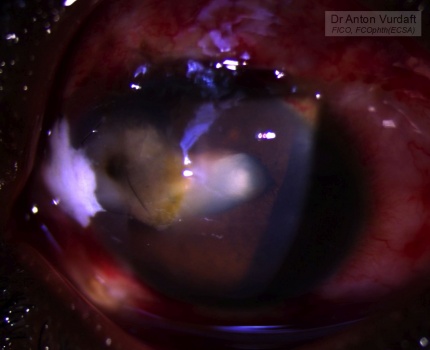 Fish-hook eye perforation - corneal scar and traumatic cataract