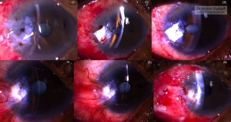 Pterygium excision caused corneal perforation.
