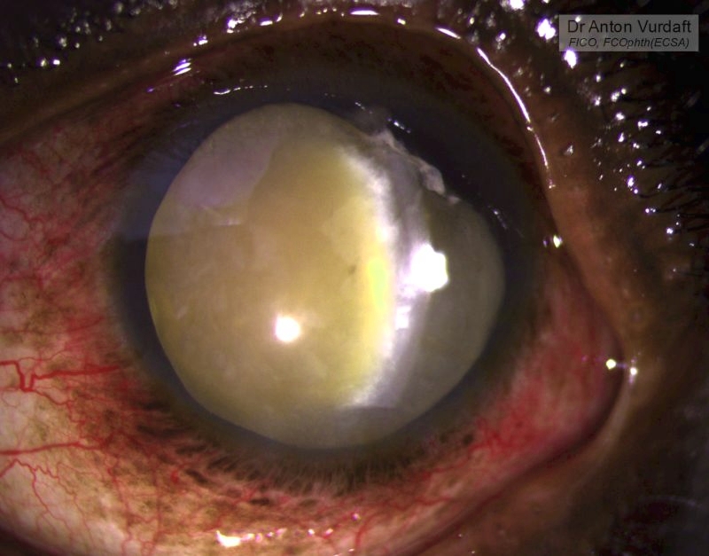 Traumatic anterior lens dislocation 