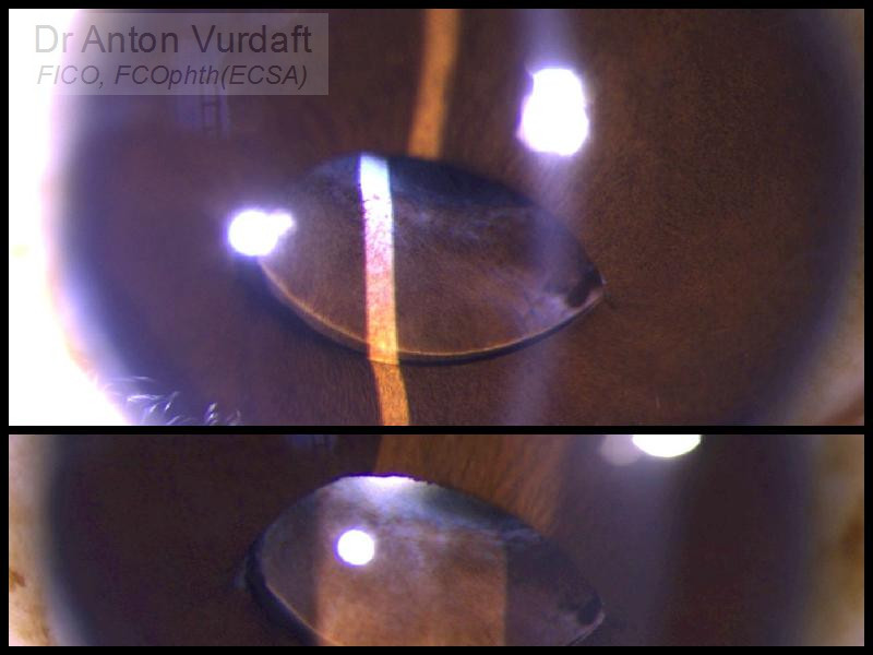 Intraocular lens optic partial pupil capture in pediatric case