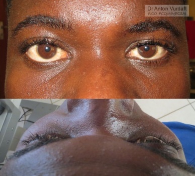 Non-traumatic enophthalmos left eye