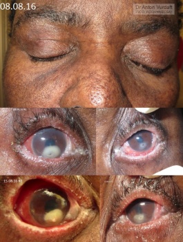 Stevens-Johnson Syndrome of the Eye