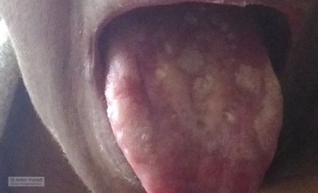 Candidiasis of oral cavity mucous membranes in AIDS