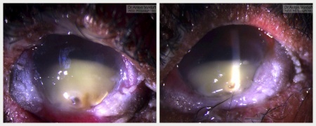 Stevens-Johnson Syndrome of the eye: severest keratoconjunctivitis sicca and bilateral keratitis with secondary infection (bilateral cornea abscess)
