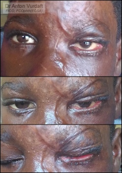 Cicatricial ectropion upper lid after skin-grafting