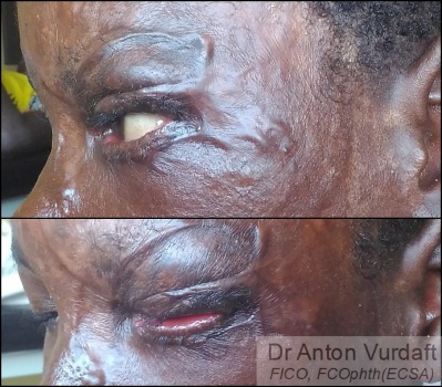 Cicatricial ectropion upper lid 2 months after skin-grafting