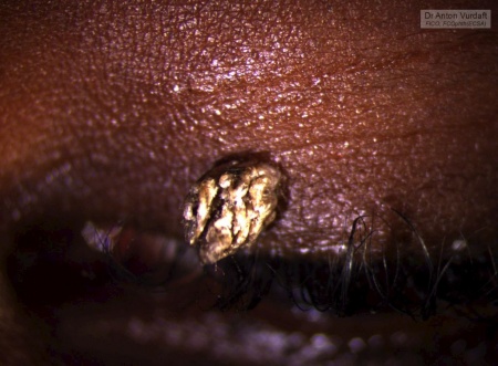 Golden upper eyelid papilloma