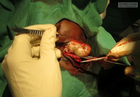 Periorbital dermoid cyst excision