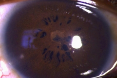 Subtotal persisting pupillary membrane