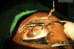 Eye fish-hook perforation