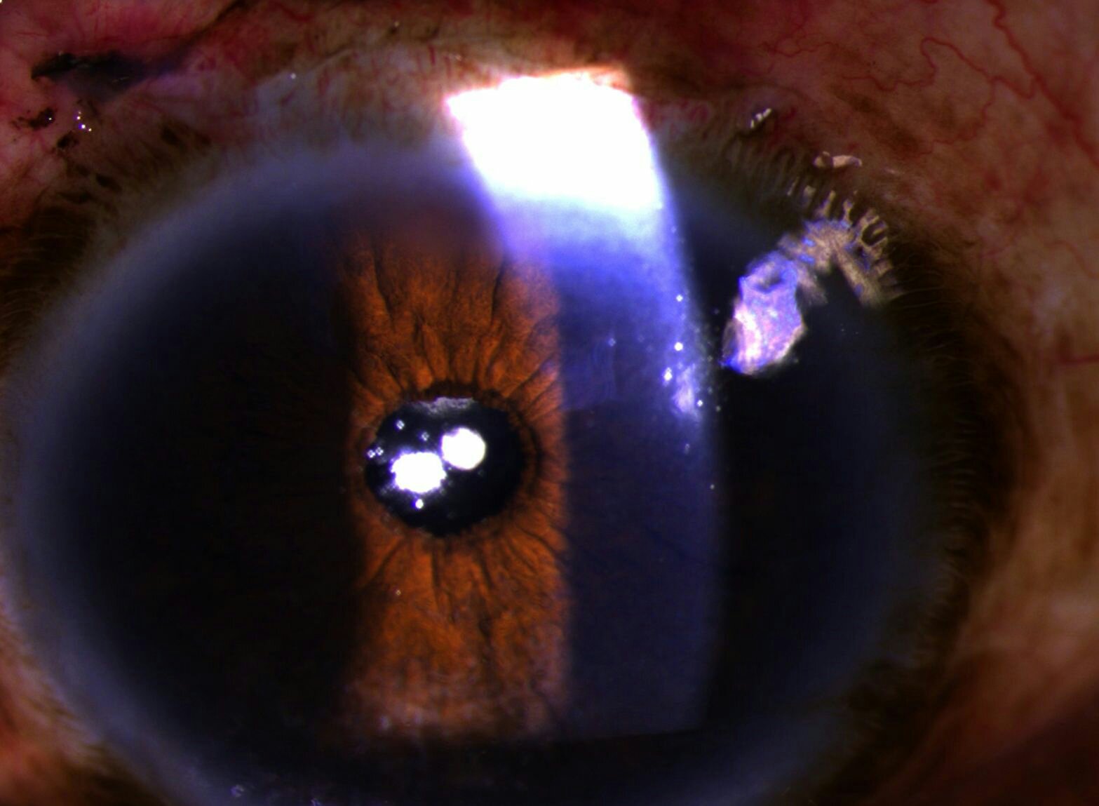 Postoperative status: SICS in Morgagni cataract