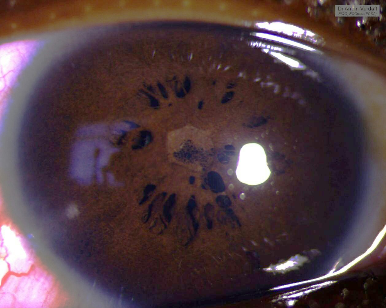 Severe persistent pupillary membrane