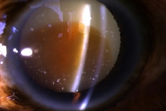 Morgagnian cataract