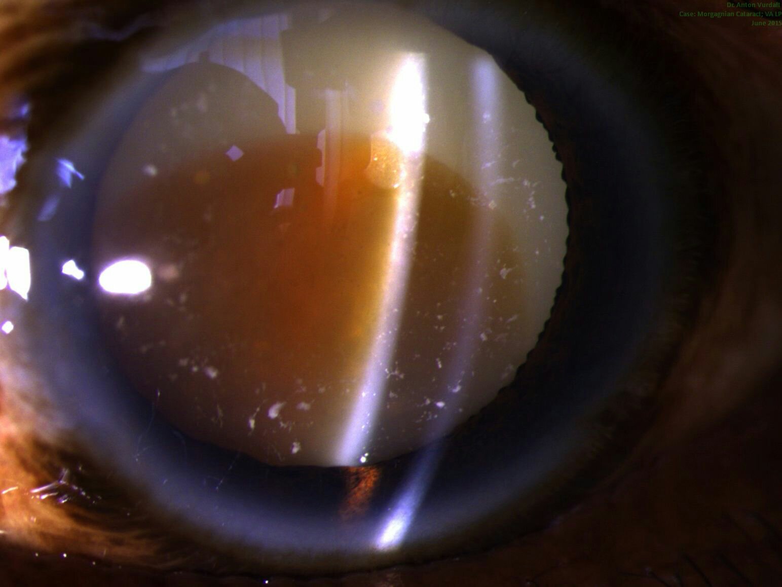 Morgagni cataract: pre-op status