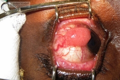 Squamous cell carcinoma of the conjunctiva